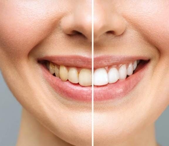 Boca sonriente con una comparación de antes y después que muestra dientes descoloridos a la izquierda y dientes blanqueados a la derecha.