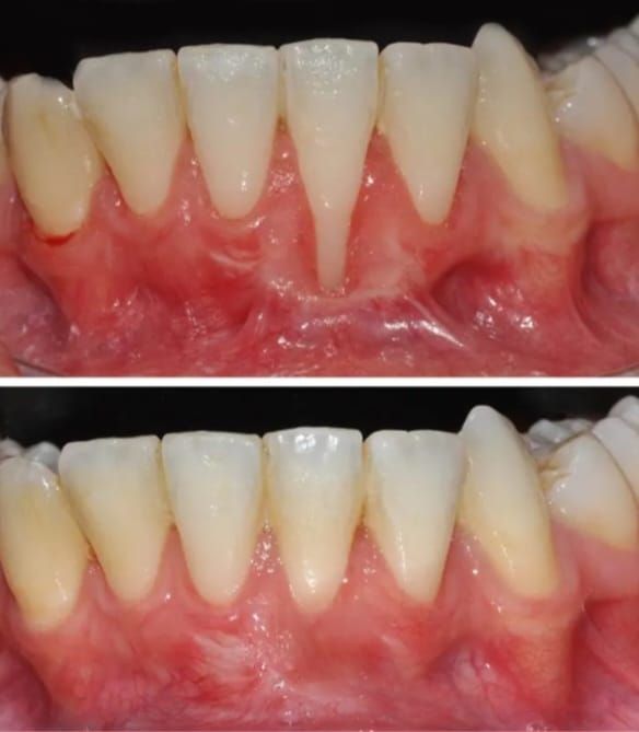Arriba: Retracción gingival con raíz dental expuesta. Abajo: Mejora del aspecto de las encías tras el tratamiento.