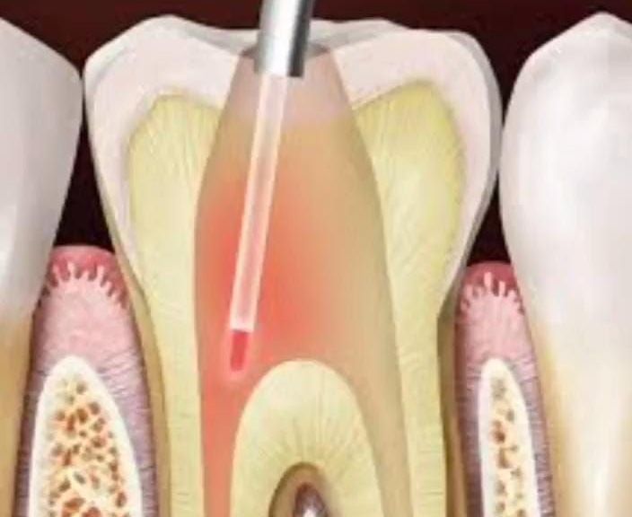 Diagrama de un diente siendo tratado con láser durante una endodoncia. Luz roja brillante dentro del diente.