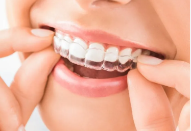 Persona insertándose alineadores transparentes en la boca; se ven los dedos.