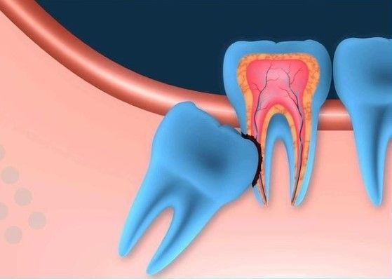 Ilustración de un diente impactado con conducto radicular visible, rodeado de tejido gingival.