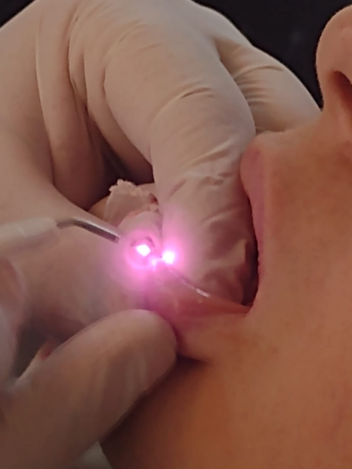 Una mano enguantada utiliza un láser sobre la boca de una persona. Del láser emana una luz rosa.