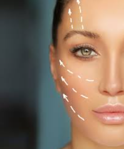 Rostro de mujer con líneas punteadas y flechas que indican las áreas para un procedimiento cosmético.