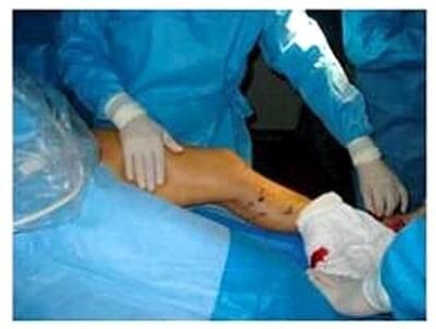 ANGIOLOGÍA Y CIRUGÍA VASCULAR DR. ERNESTO PACHECO P