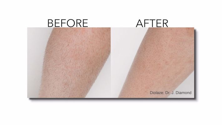 before and after results of laser hair removal.
