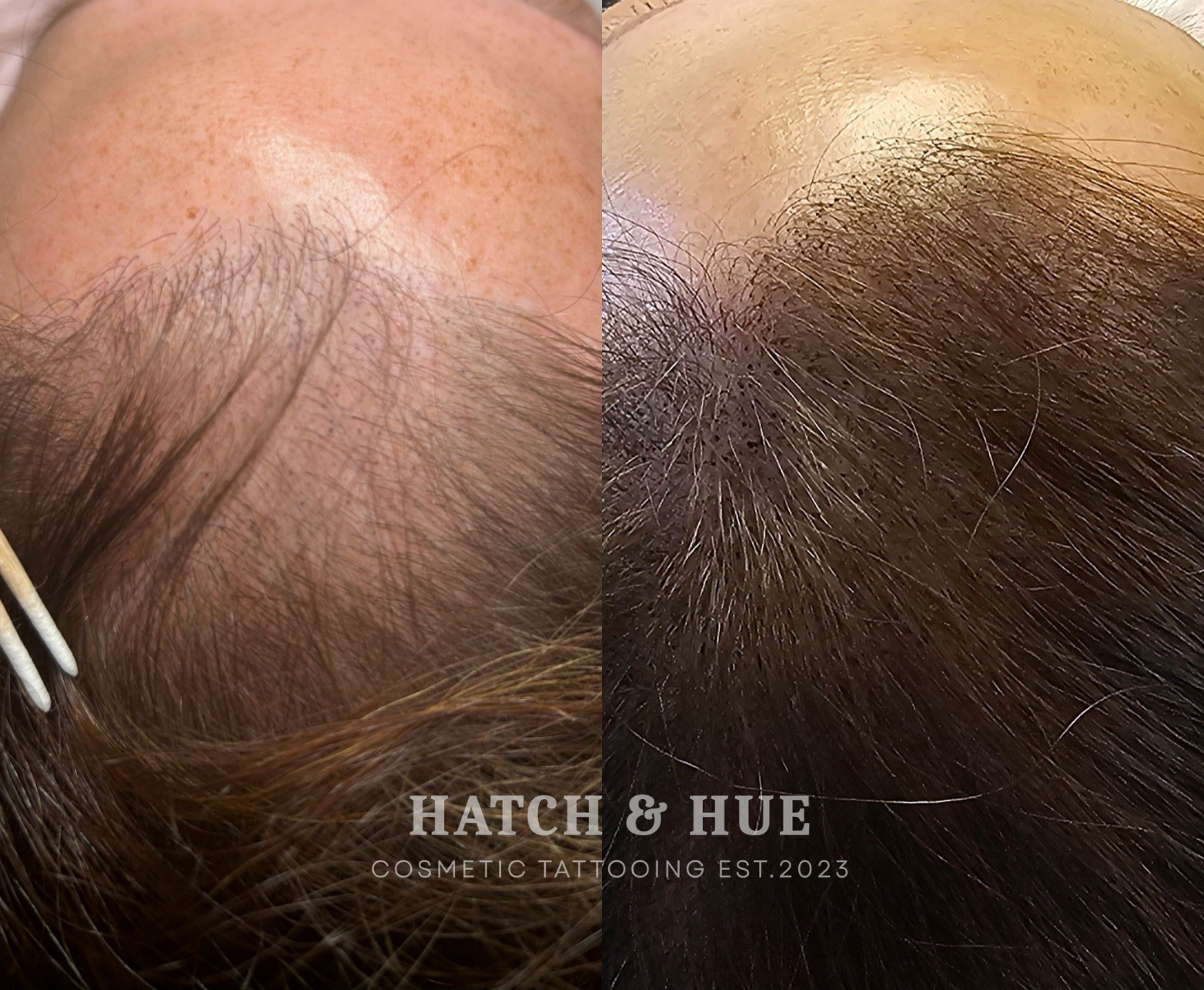 Comparison of thinning hair before and after cosmetic scalp micropigmentation treatment.