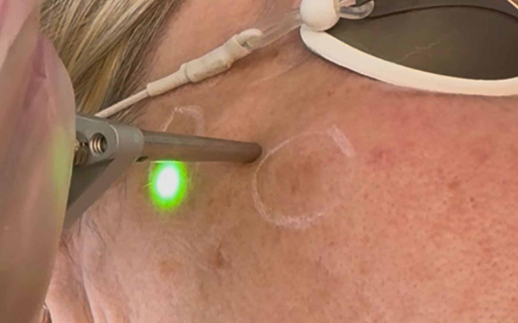 Skin Pigmentation