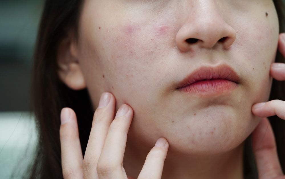 A close up of a woman 's face with acne on it.