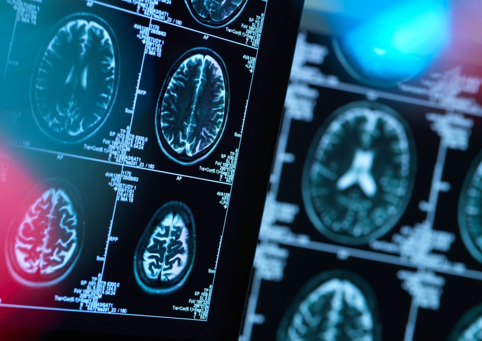 Why You Should Seek a Lawyer if You've Suffered a Brain Injury in Wisconsin
