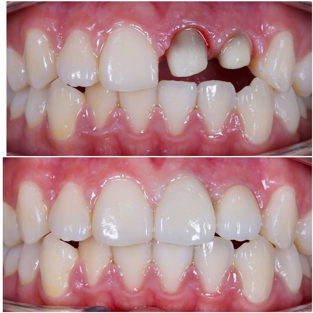 SMILE GALLERY - TLC Dental Wellness