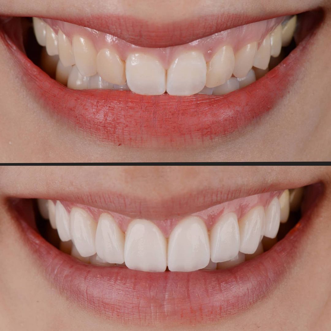 SMILE GALLERY - TLC Dental Wellness