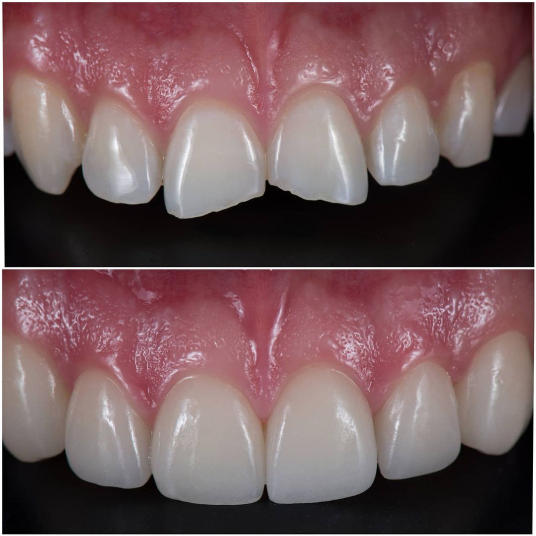 SMILE GALLERY - TLC Dental Wellness