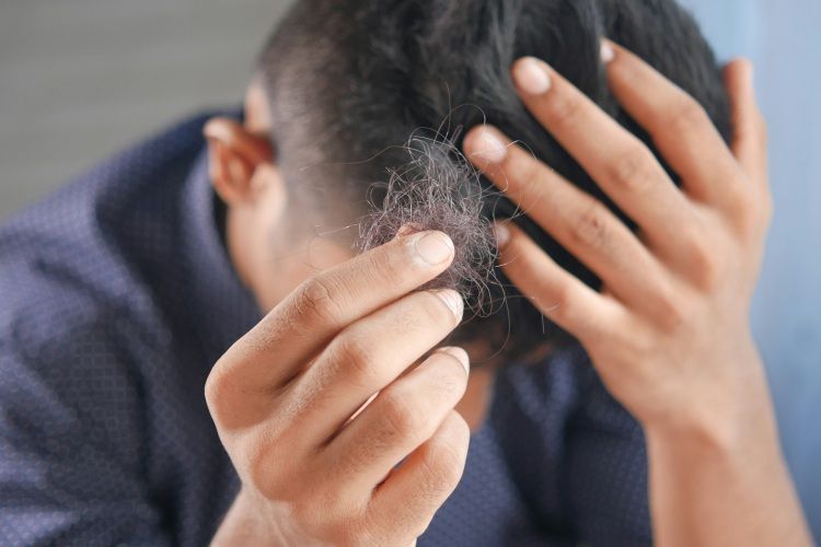 man showing hair falling out