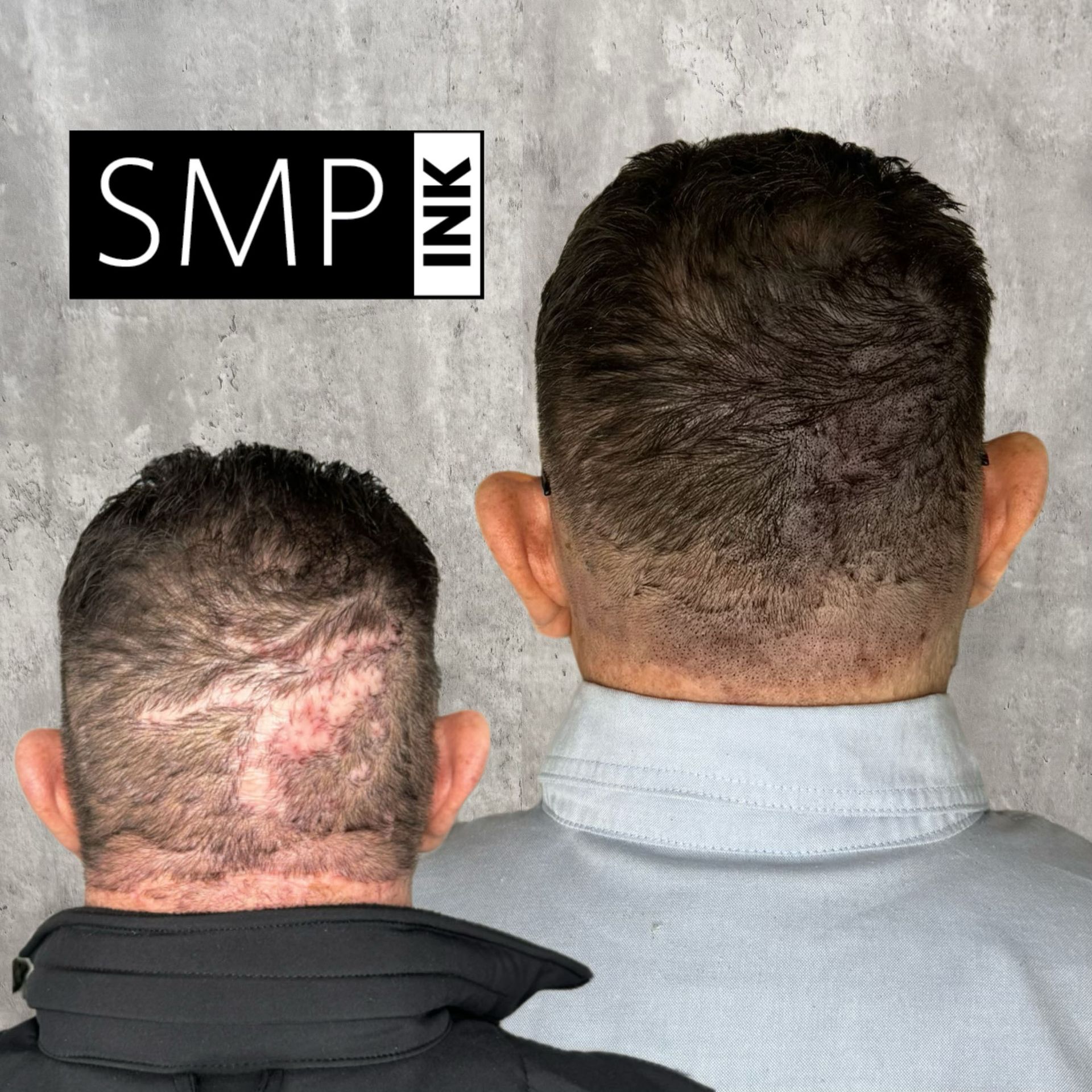 Results of SMP scar camouflage treatment