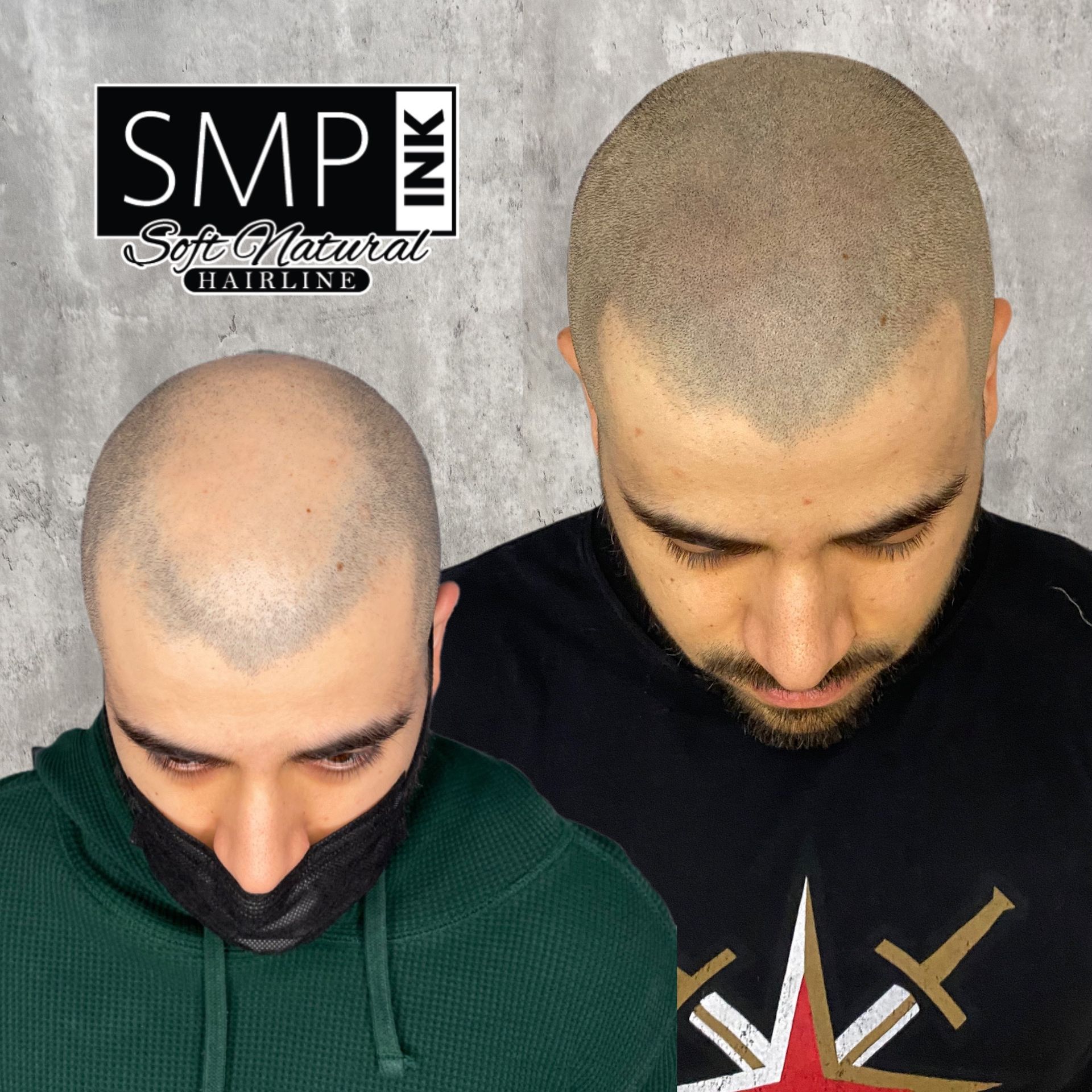 Scalp Micropigmentation results of male client