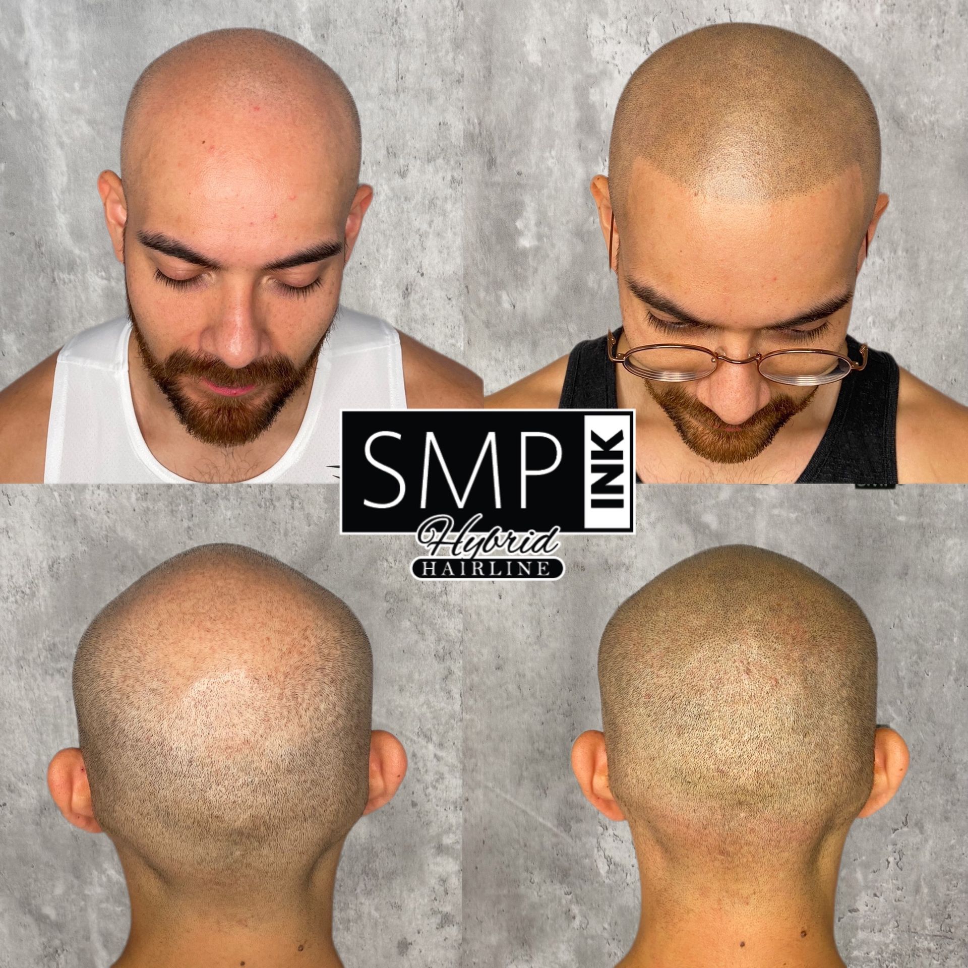 Before and after of scalp micropigmentatioin service