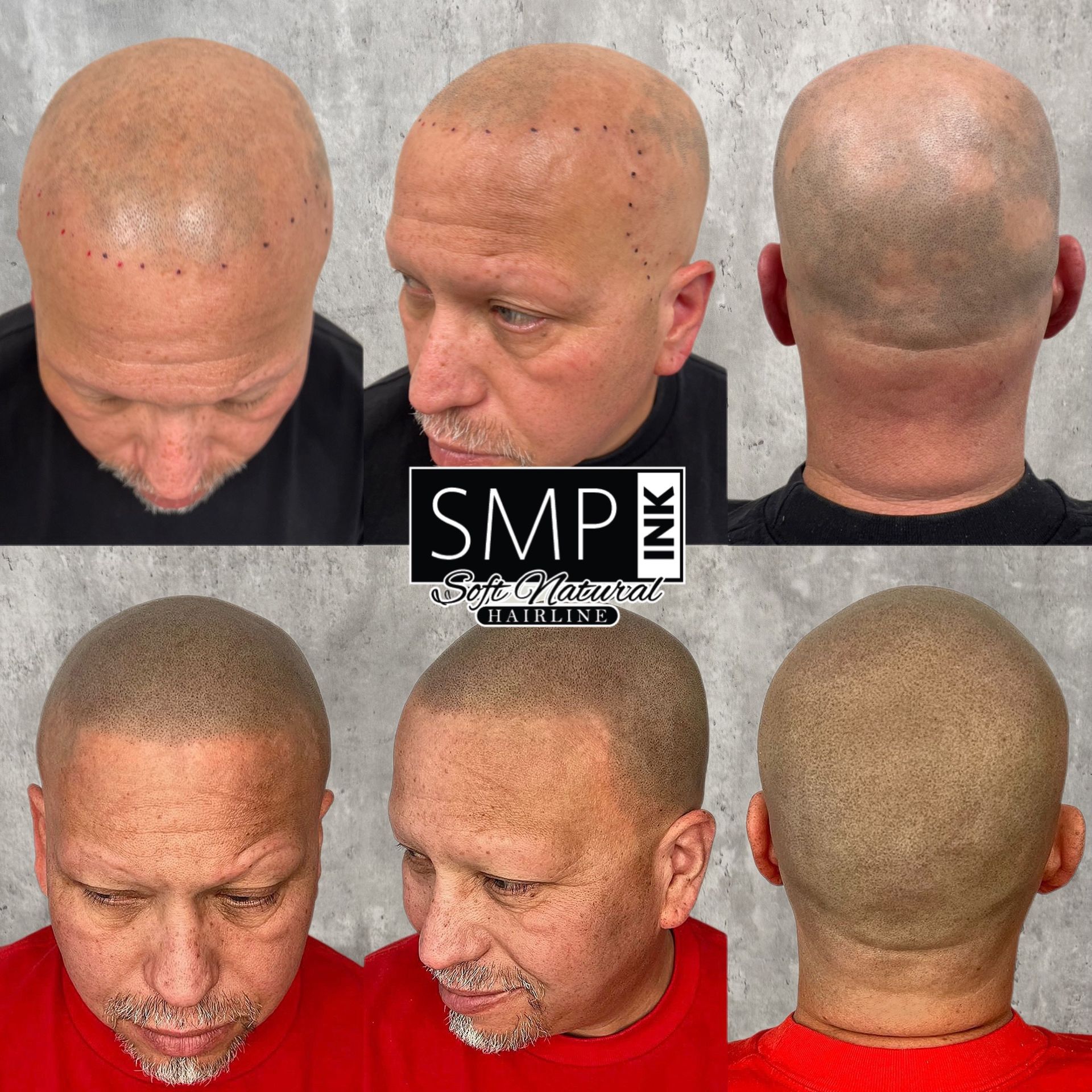 The effects of scalp micropigmentation density fill by SMP INK CDA