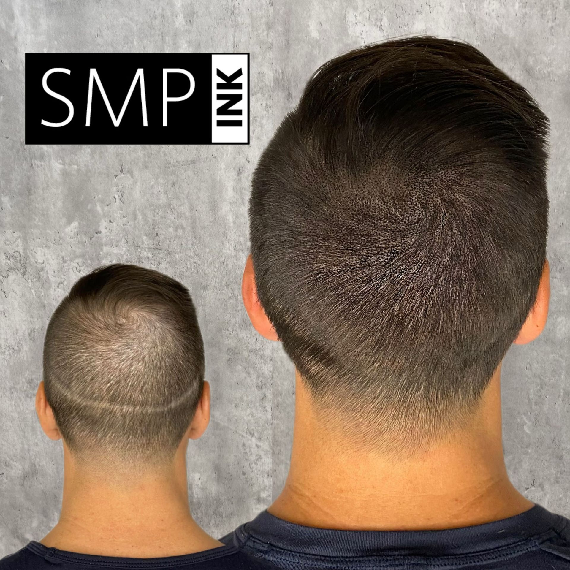 Results of SMP scar camouflage treatment
