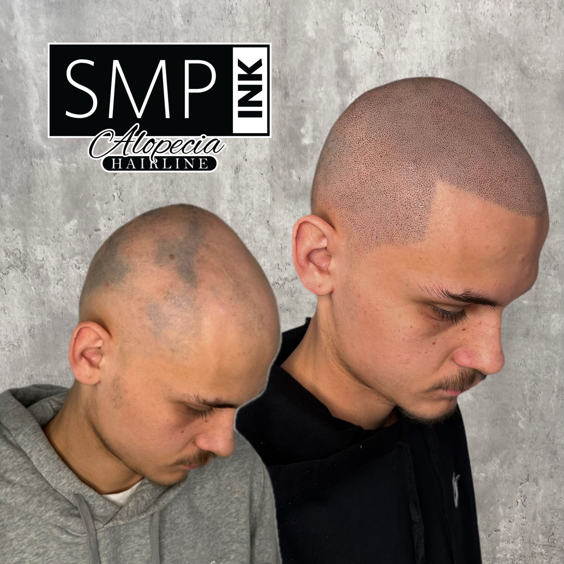 Alopecia Treatment utilizing SMP
