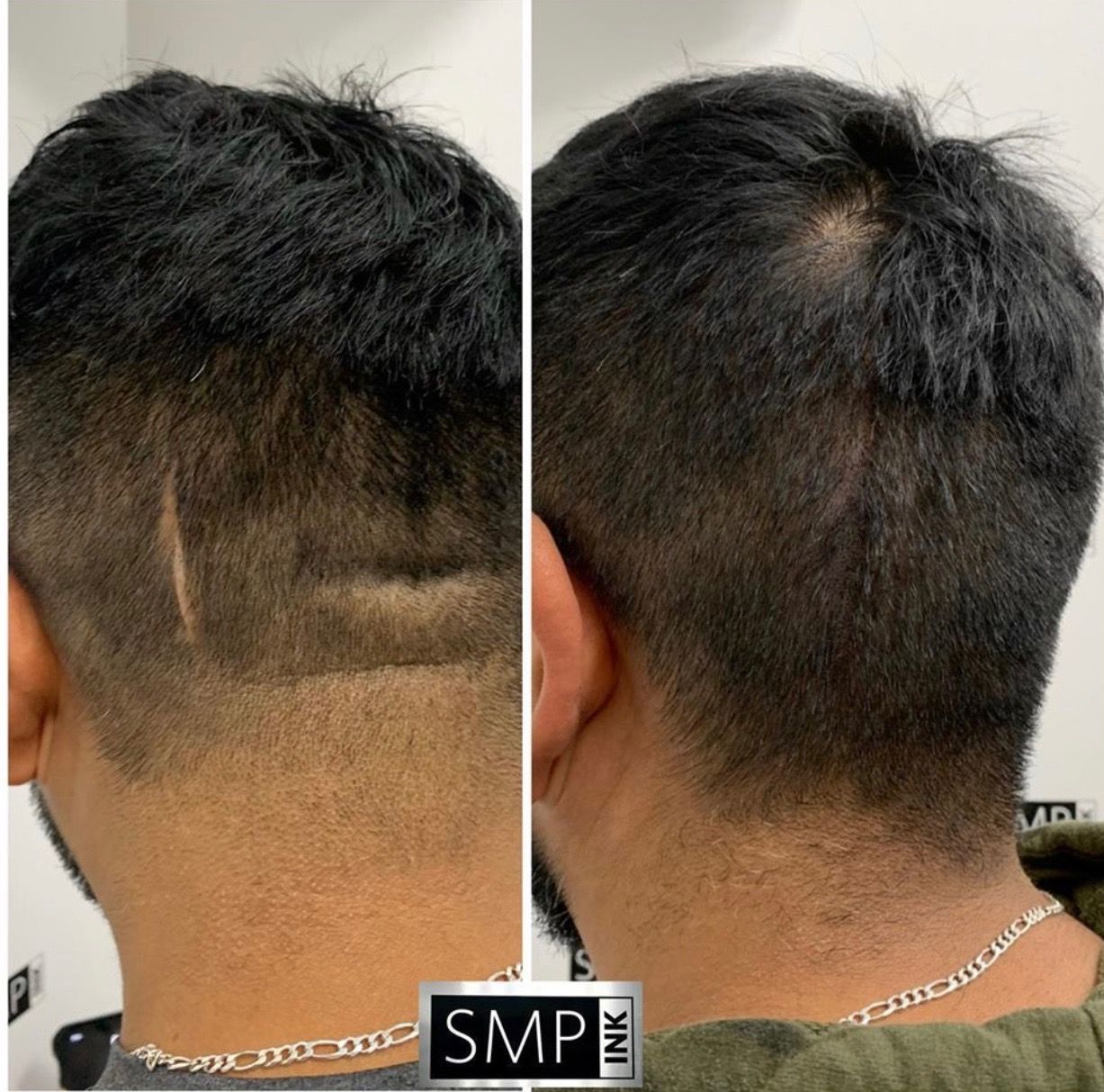 Before and after of SMP scar camouflage treatment