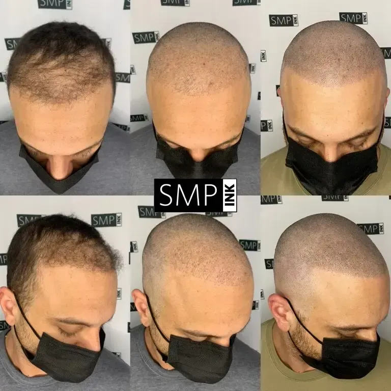 before and after receiving SMP from SMP INK