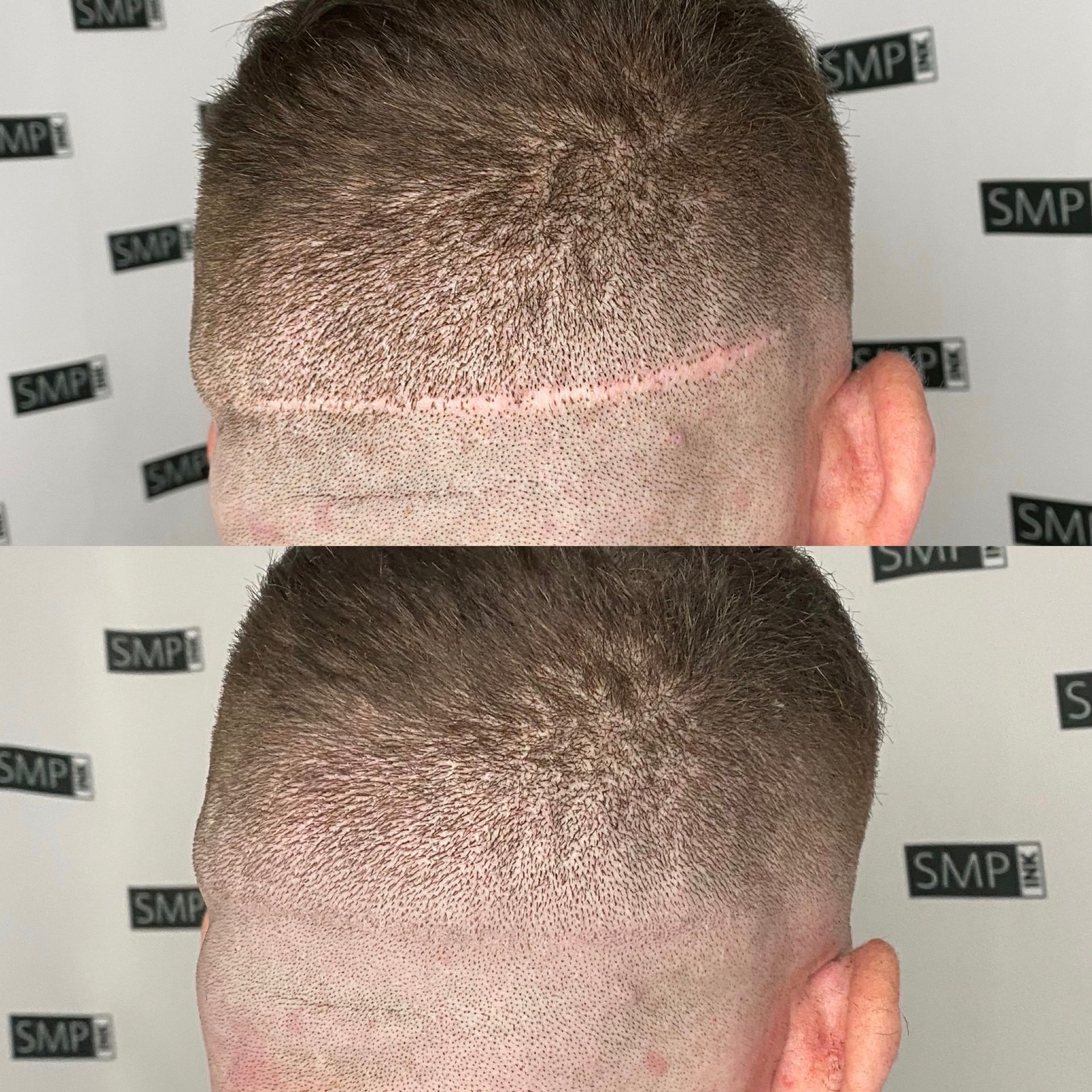example of SMP scar camouflage treatment before and after