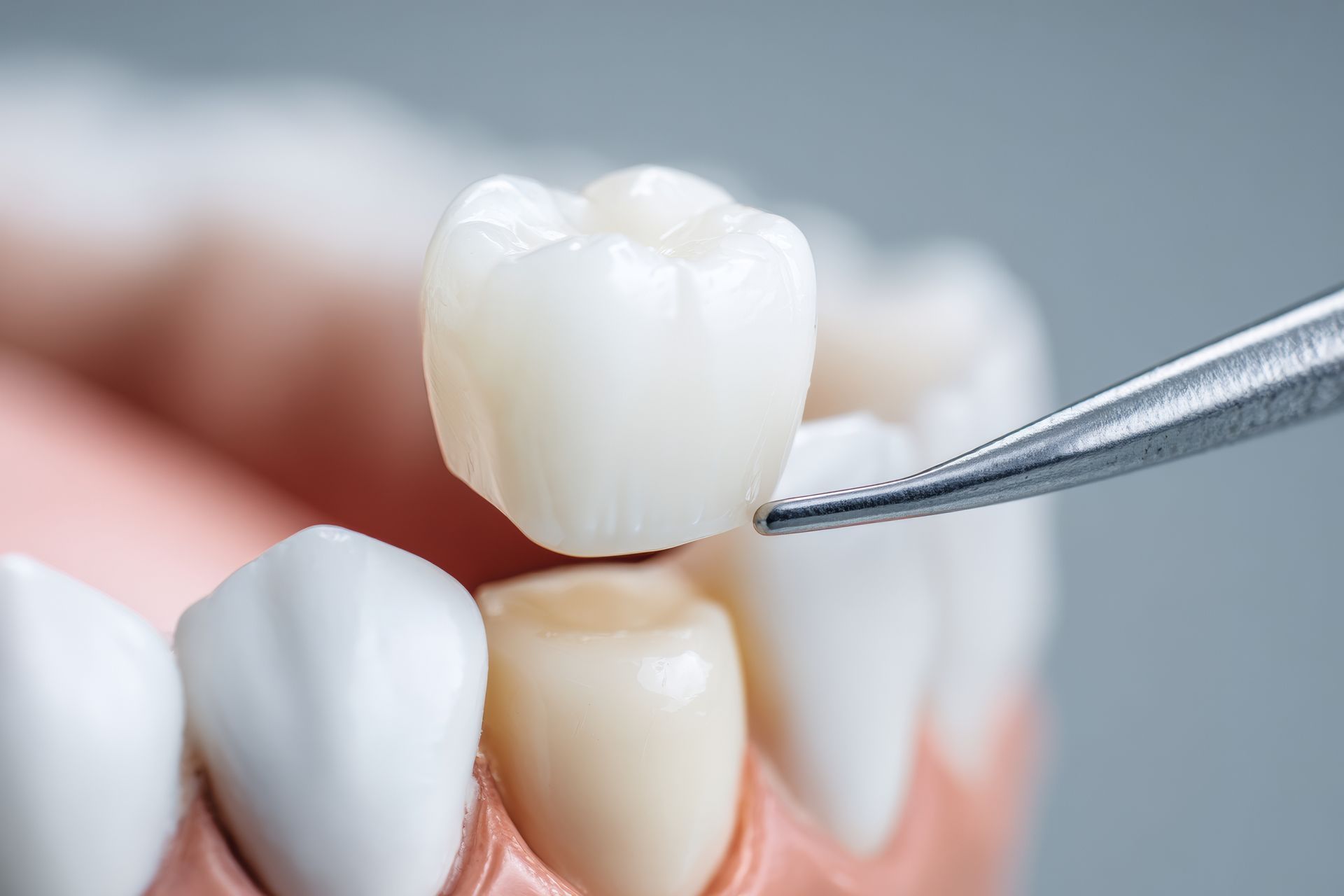 Dentist Places Ceramic Crown on Patient Tooth in Dental Clinic During Treatment Session Dentist Places Ceramic Crown on Patient Tooth in Dental Clinic During Treatment Session