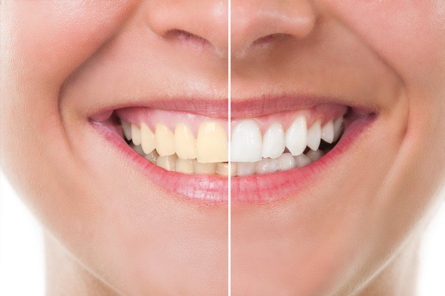 Smile Simulation for Dental Procedures — Baker, LA — Rabel Family Dentistry
