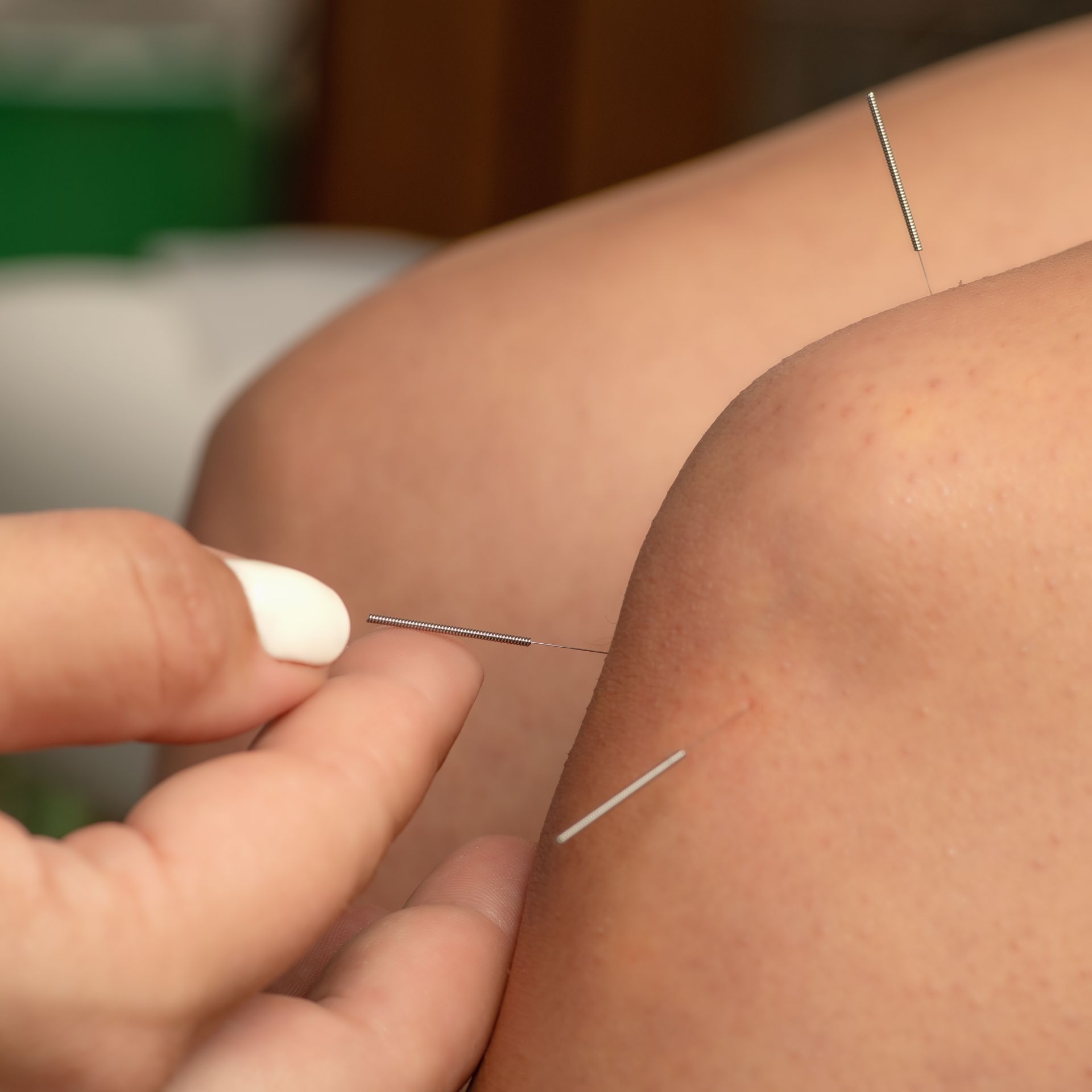 A person is getting acupuncture on their knee