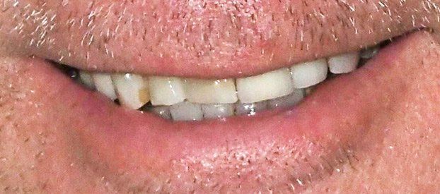 Dental Fillings Before