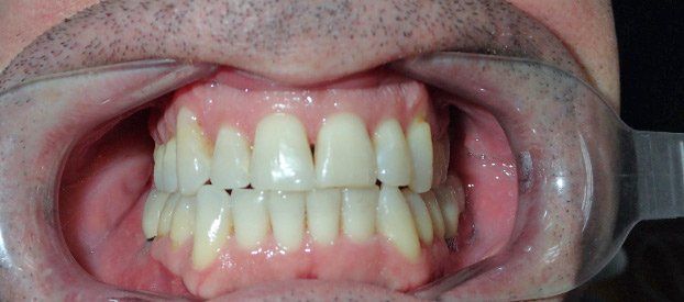 Dental Fillings Before