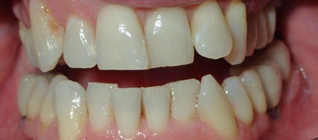 Dental Fillings Before