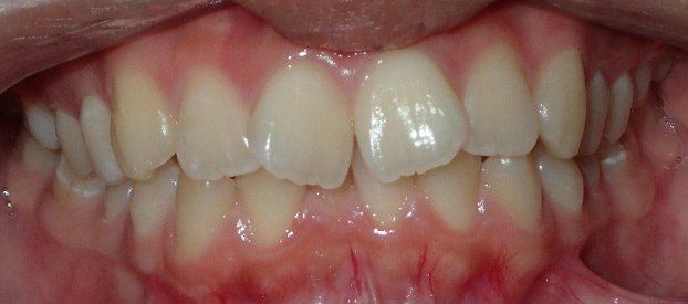 Dental Fillings Before