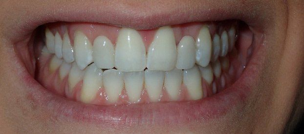 Dental Fillings Before