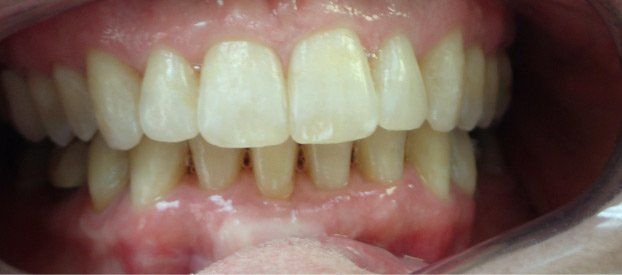 Dental Fillings Before