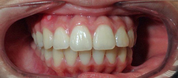 Dental Fillings Before