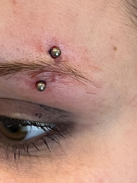 Een close-up van een wenkbrauwpiercing met zichtbare roodheid en irritatie rond de insteek- en uitgangspunten.