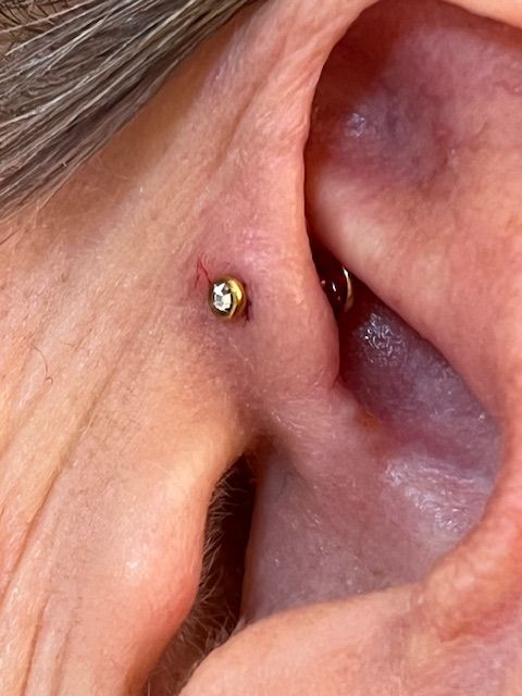 Een close-up van een oor met een goudkleurige oorbel in de tragus, met roodheid en irritatie rondom de piercing.