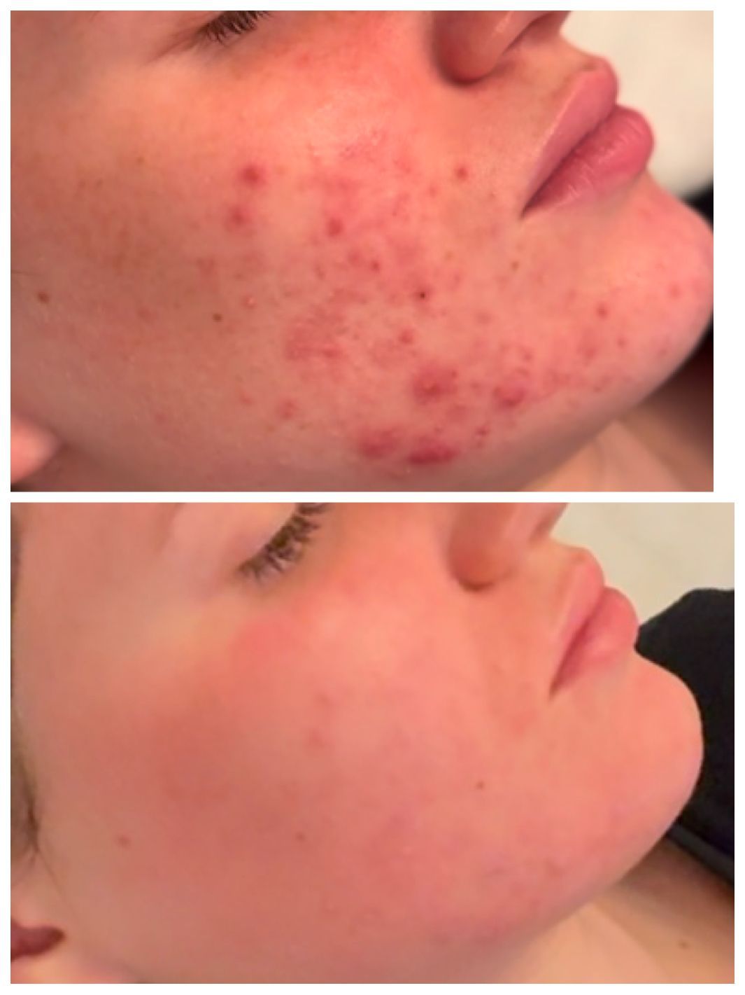 Before-and-after photos of a person's face. The top photo shows acne. The bottom photo shows clear skin.