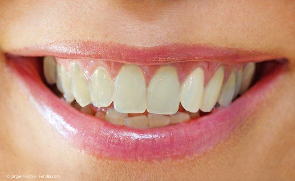 Dunkle Zähne vor der Zahnaufhellung