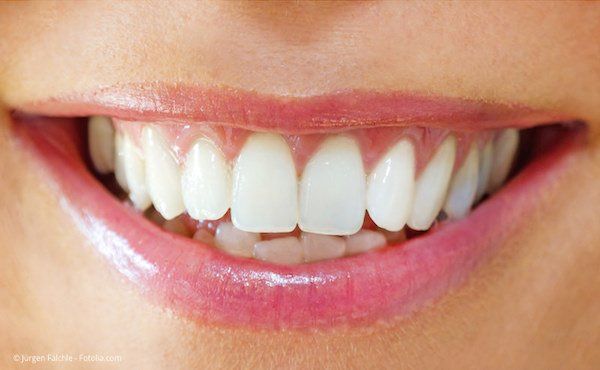Weiße Zähne nach dem Bleaching