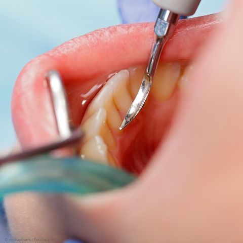 Zahnsteinentfernung mit Ultraschall
