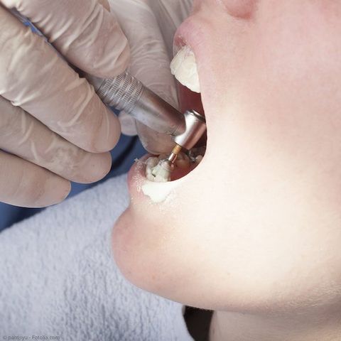 Zahnpolitur bei der Professionellen Zahnreinigung