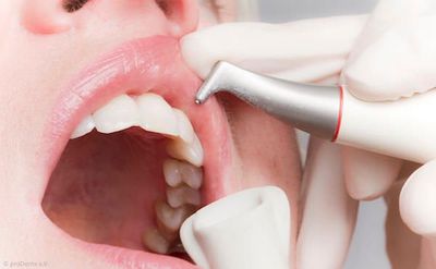Beseitigung von Zahnbelag mit dem Pulverstrahlgerät
