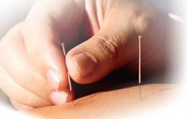 A Person is Getting an Acupuncture Treatment on Their Back — Alchemy Wellness Centre In Bangalow, NSW