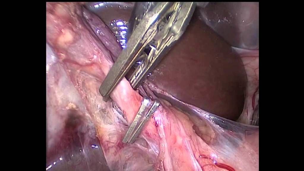 A Close up Of a Surgical Procedure Being Performed on A Liver — Alchemy Wellness Centre In Bangalow, NSW