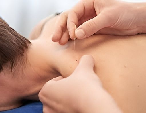 A Person Is Getting Acupuncture on Their Back — Alchemy Wellness Centre In Bangalow, NSW