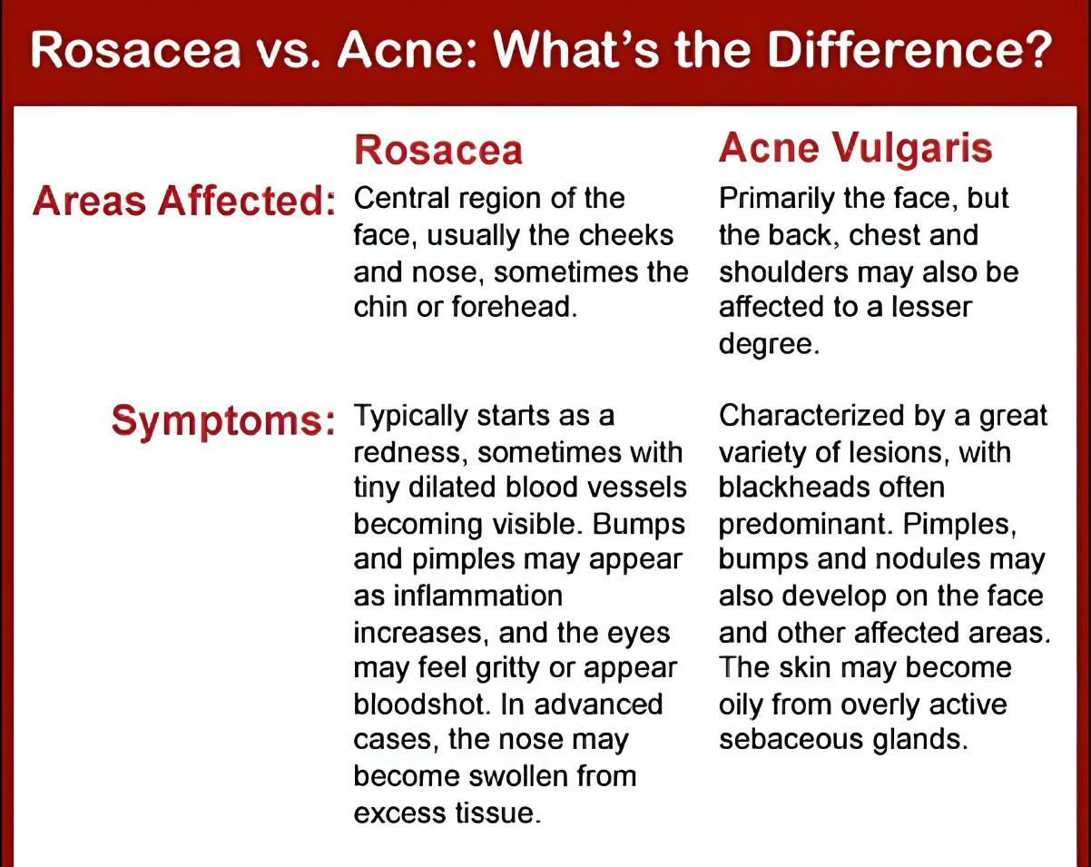 A Poster Explaining the Difference Between Rosacea and Acne — Alchemy Wellness Centre In Bangalow, NSW
