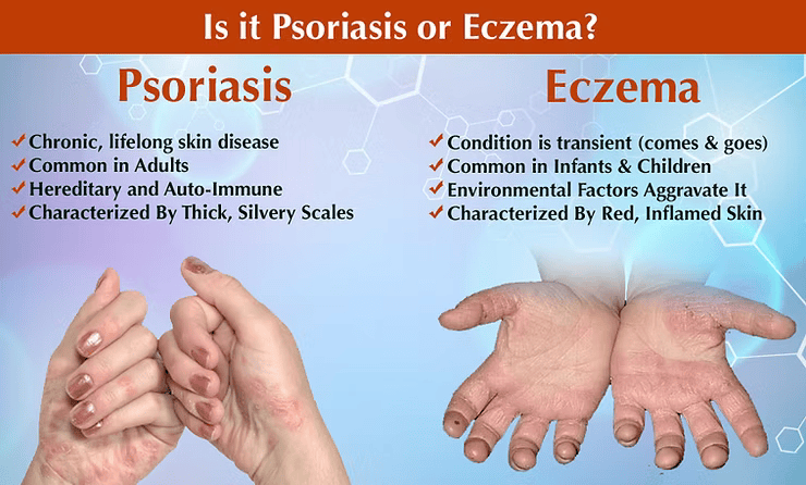 A Poster Showing the Difference Between Psoriasis and Eczema — Alchemy Wellness Centre In Bangalow, NSW