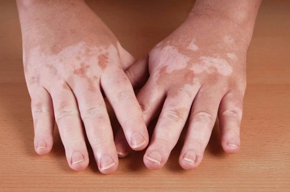 mani con patologia dermatologica